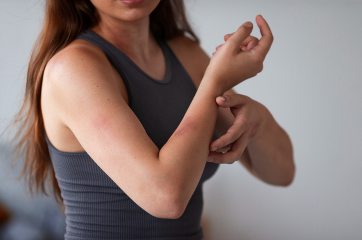 Atopic Dermatitis image