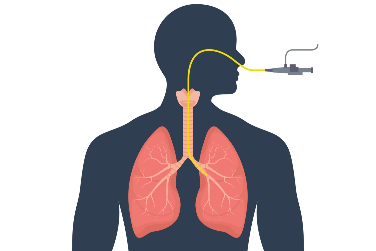 Bronchial Asthma image