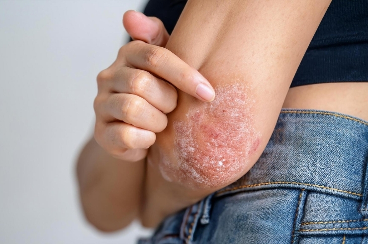 Eczema image
