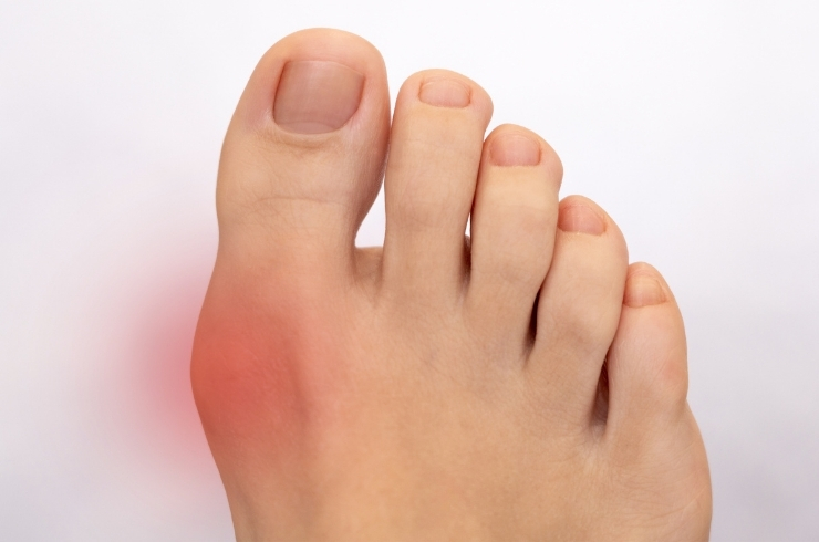 Gout image