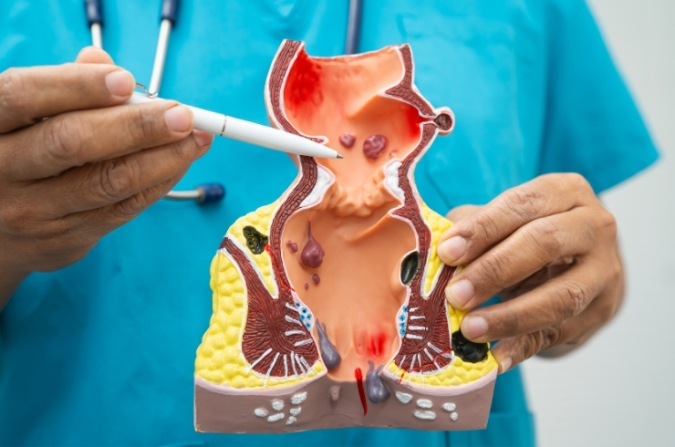 Hemorrhoids, Fissure, Fistula image