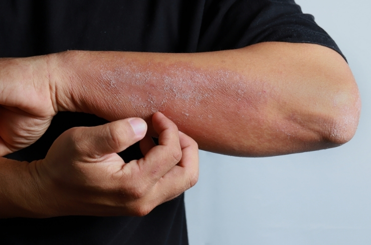 Lichen Planus image