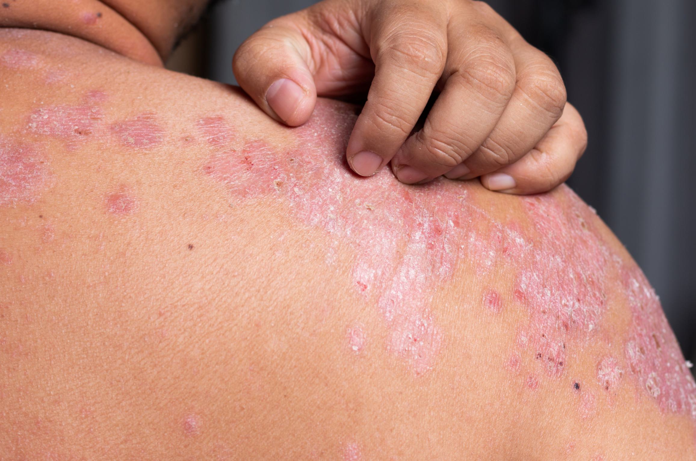 Psoriasis image