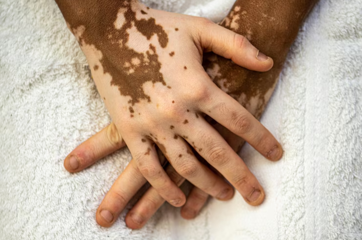 Vitiligo image