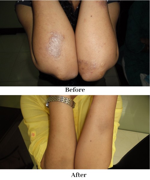 Atopic Dermatitis
