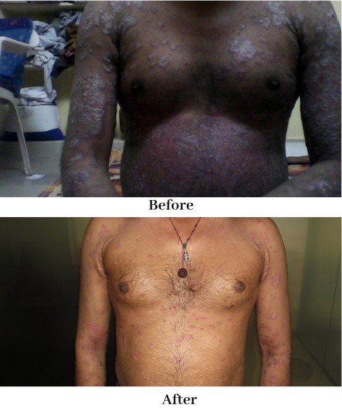 psoriasis