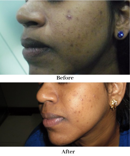 Acne and Pigmentation