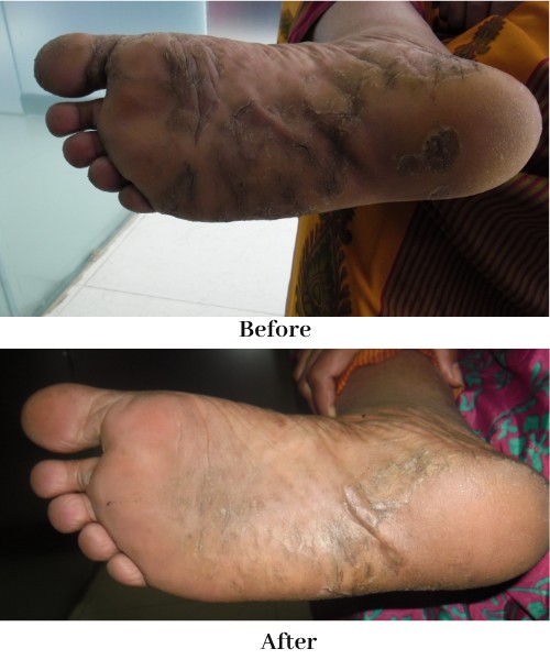 Psoriasis