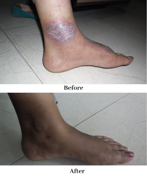Atopic Dermatitis