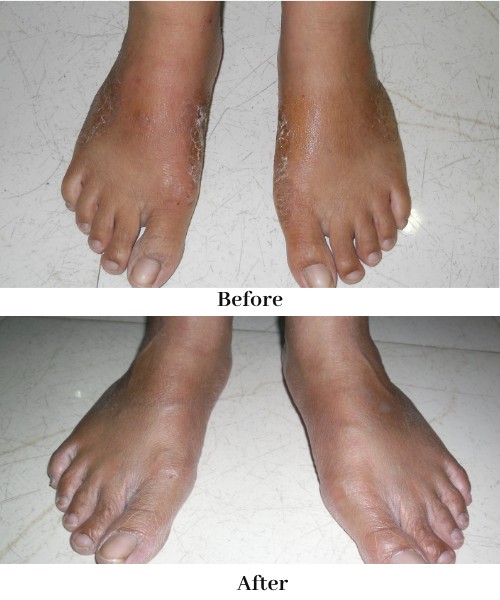 Eczema
