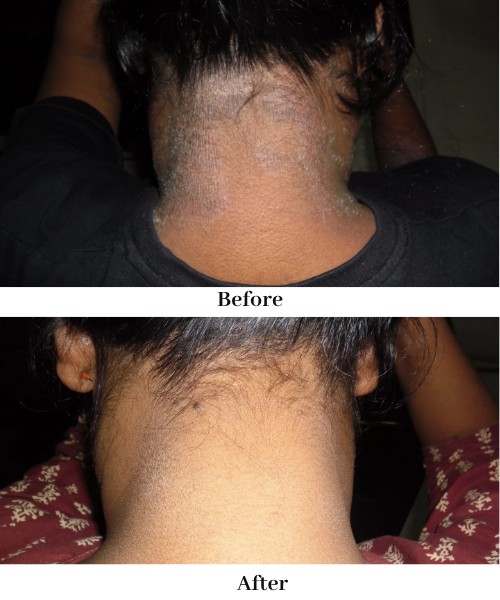 Eczema